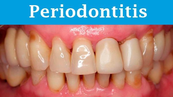 Dentadura con periodontitis
